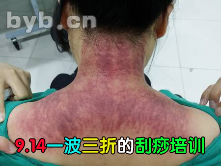 刮痧培訓